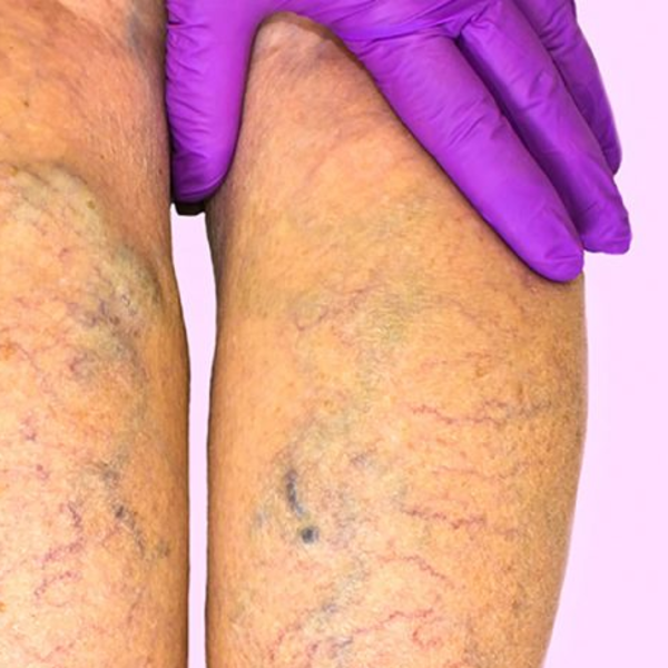 Varicose Vein Treatment 100 Pulses / Varices 100 Disparos