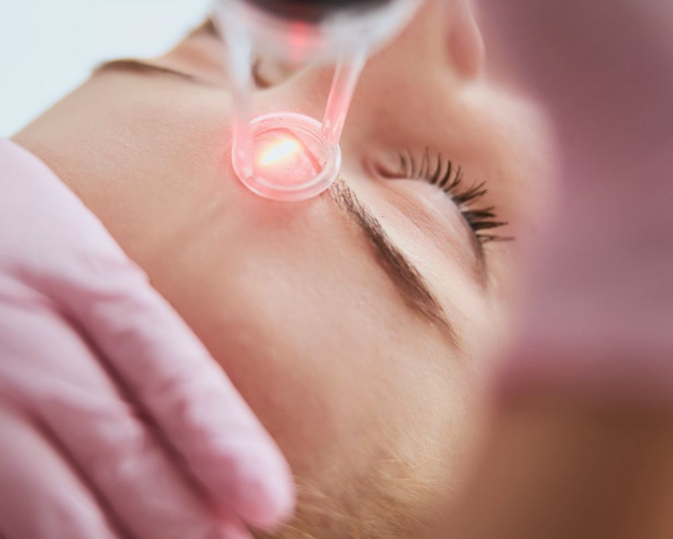 Laser CO2 Fraccionado