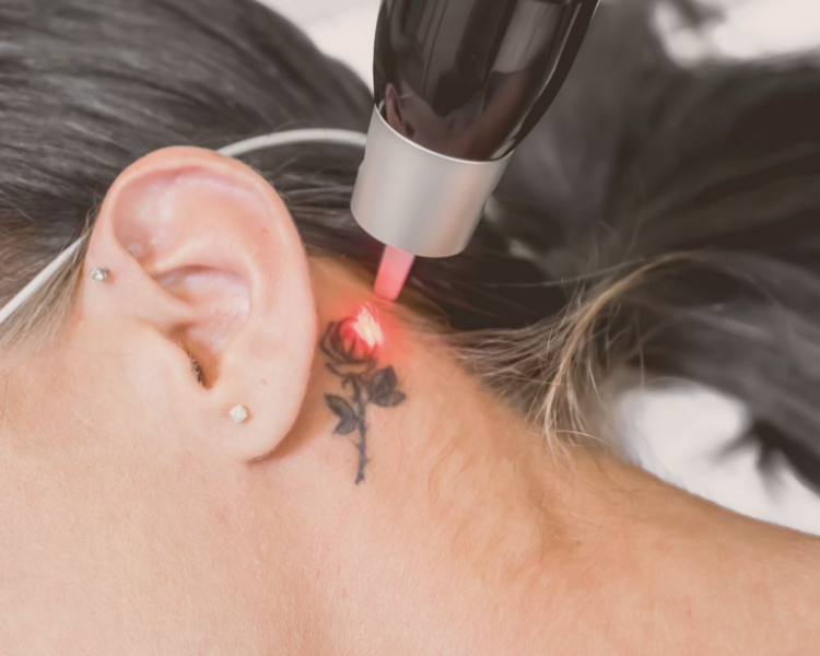 Remoción de tatuaje