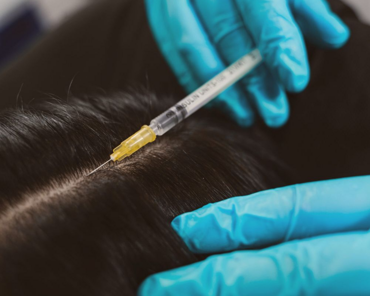 Mesoterapia capilar Nacional