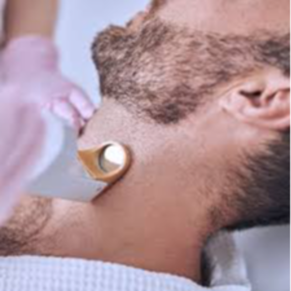 Depilación Láser en Perfilado Barba Hombre