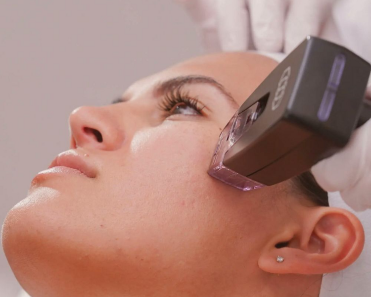 Radiofrecuencia Fraccionada  Microagujas Facial (Morpheus) 