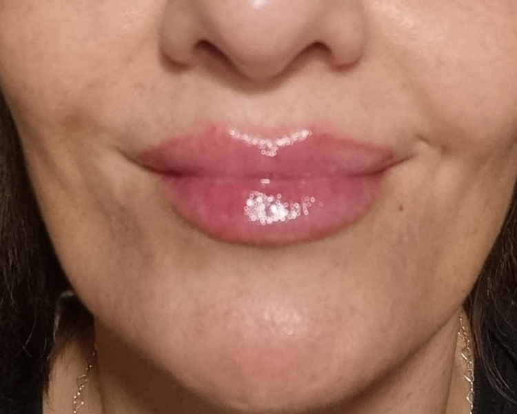 💋 Relleno de Labios – Volumen e Hidratación Natural 💳 Pagá en cuotas! 