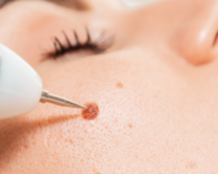 Eliminación de Verrugas