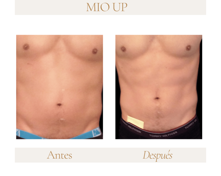 MIO UP - PACK 4 SESIONES - 3 ZONAS