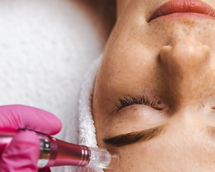 Microneedling + ADN de salmon