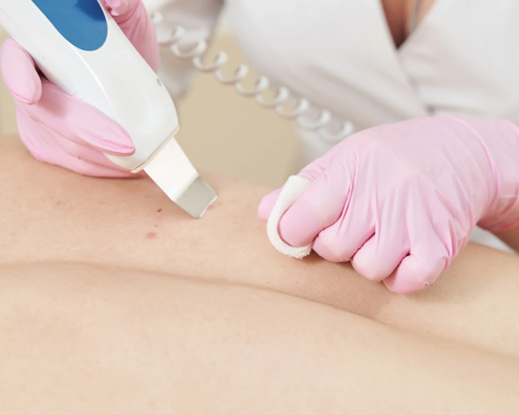 Limpieza profunda de espalda 