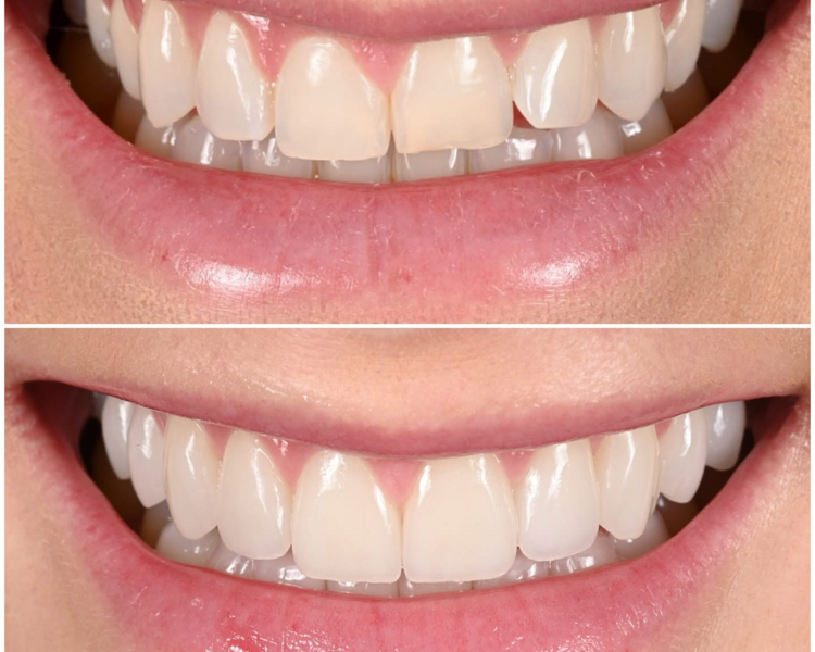 🟢🟢🟢MICRODISEÑO DE SONRISA incluye GUARDA DE BRUXISMO