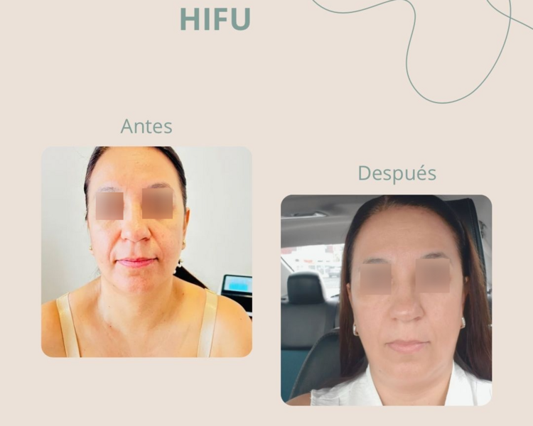 Hifu Rostro completo