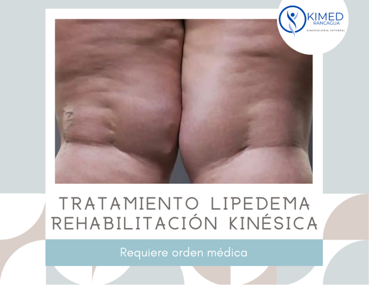 Tratamiento Kinésico para Lipedema – Piernas - Brazos