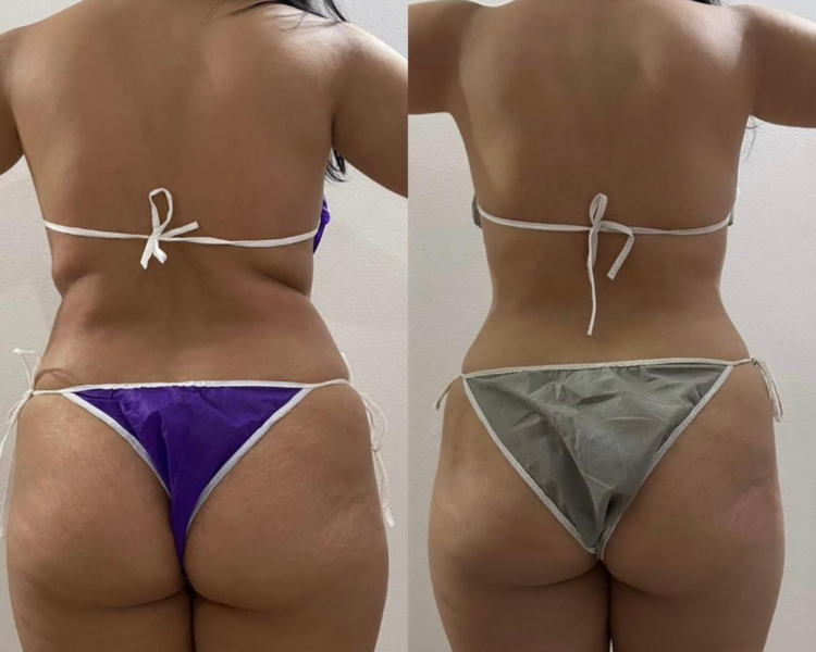 PAQUETE CUERPO COMPLETO 15 SESIONES