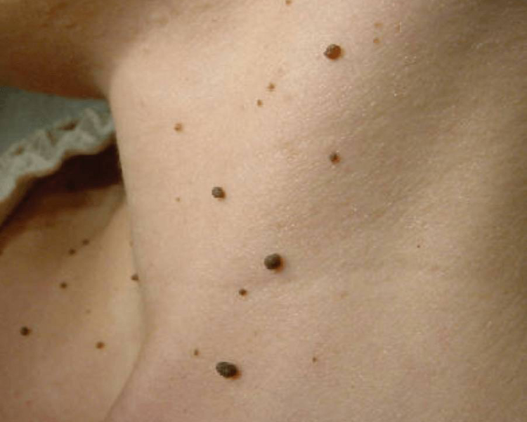 EXTRACCION DE ACROCORDONES