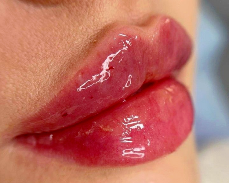 Modelado de labios con ácido hialurónico