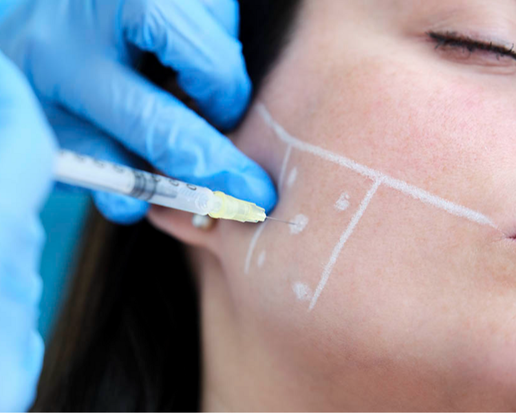 Toxina botulínica para bruxismo