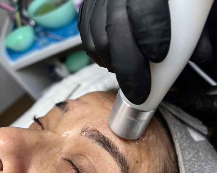 Radiofrecuencia facial