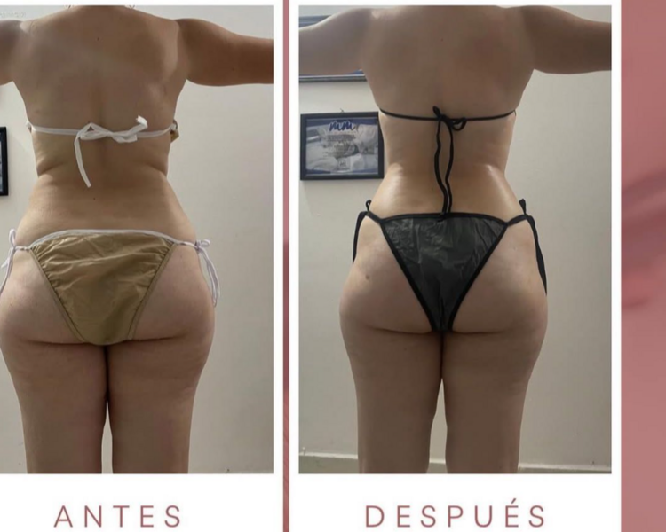 PAQUETE REDUCTOR ABDOMEN 20 SESIONES
