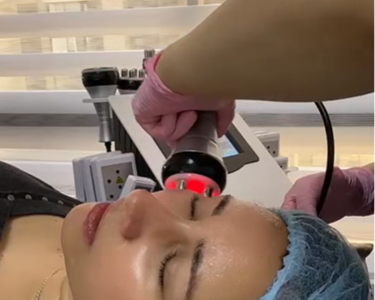 Tratamiento Lifting Facial sin cirugía (1 sesión)