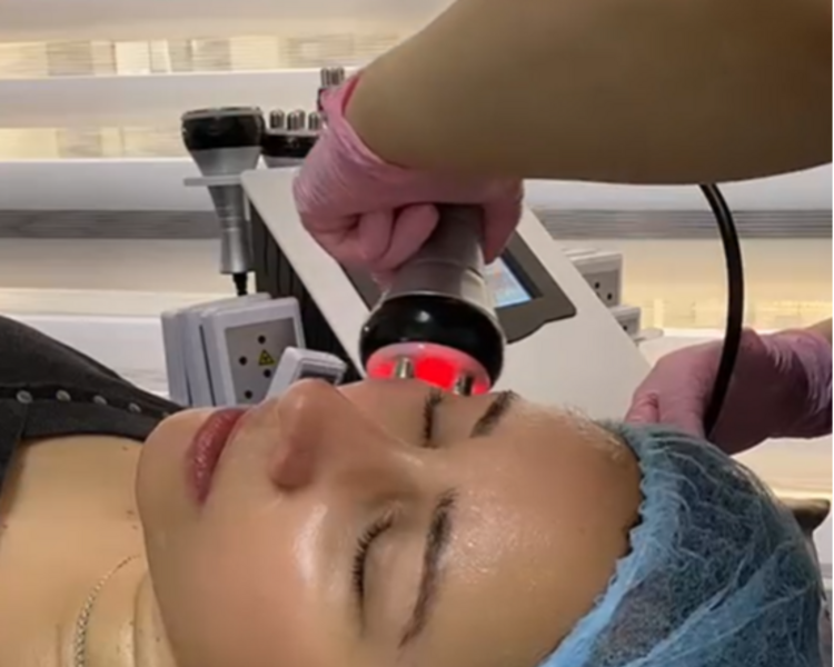 Tratamiento Lifting Facial sin cirugía (10 sesiones) 
