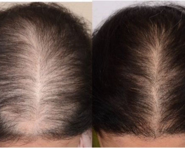 PRP Capilar (Plasma Rico en Plaquetas), 3 sesiones 