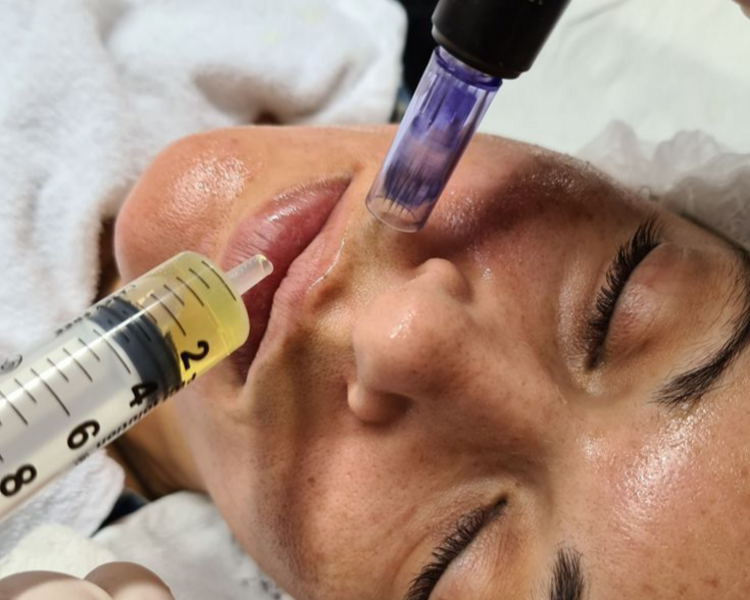 PRP (Plasma Rico en Plaquetas),  3 sesiones 