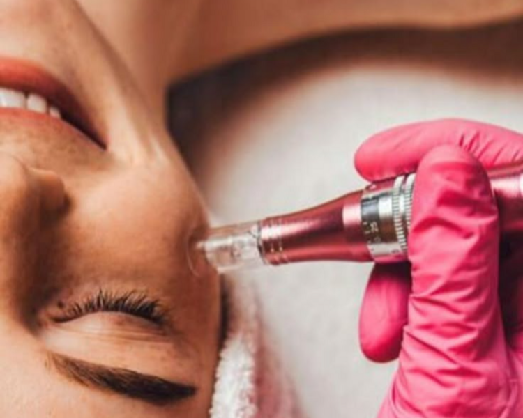 Microneedling con dermapen 