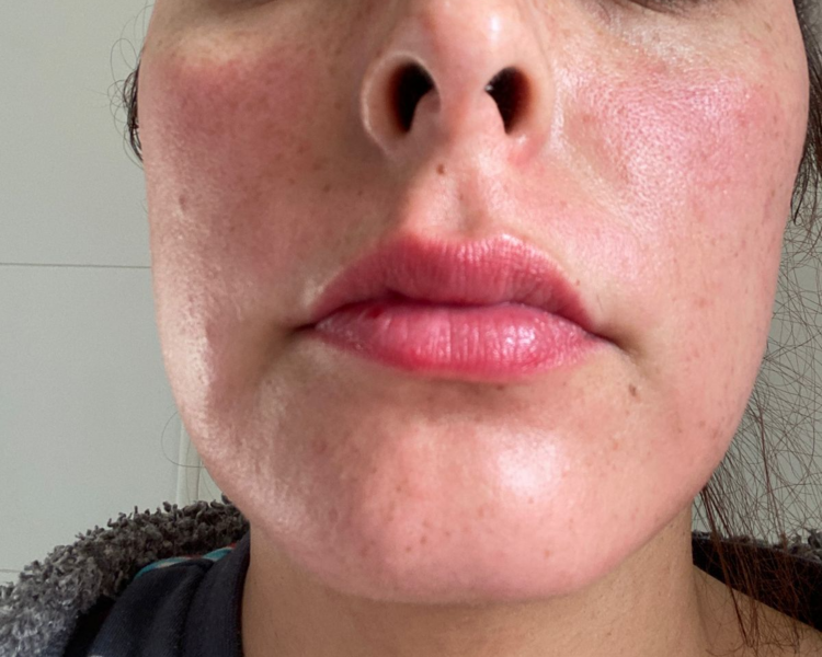 Hidra Lips 3 sesiones 