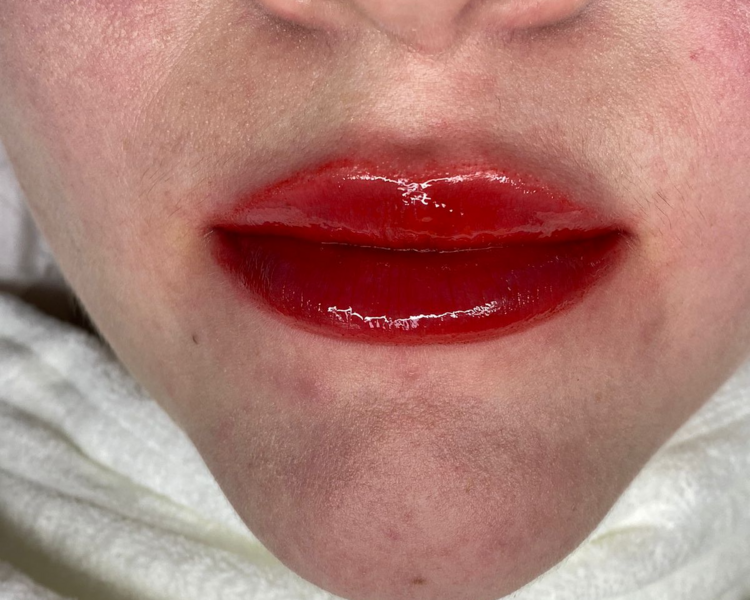 Hidra Lips + BB Lips 1 sesión 