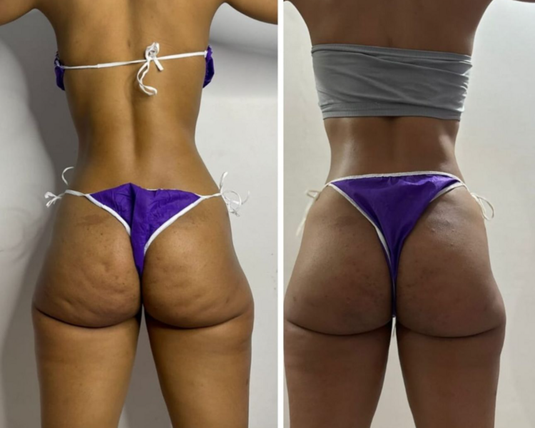 PAQUETE ANTICELULITICO 10 SESIONES