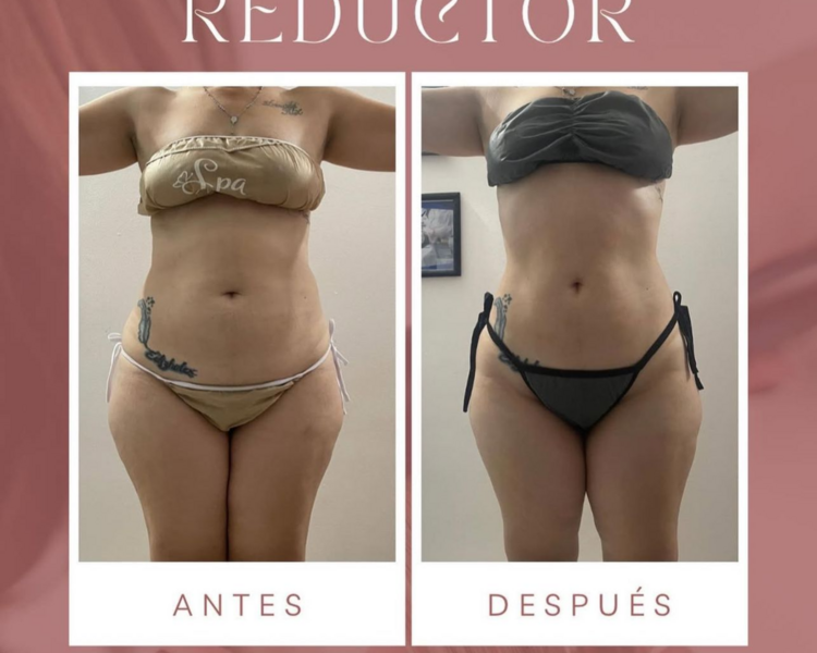 PAQUETE REDUCTOR EN ABDOMEN 8 SESIONES