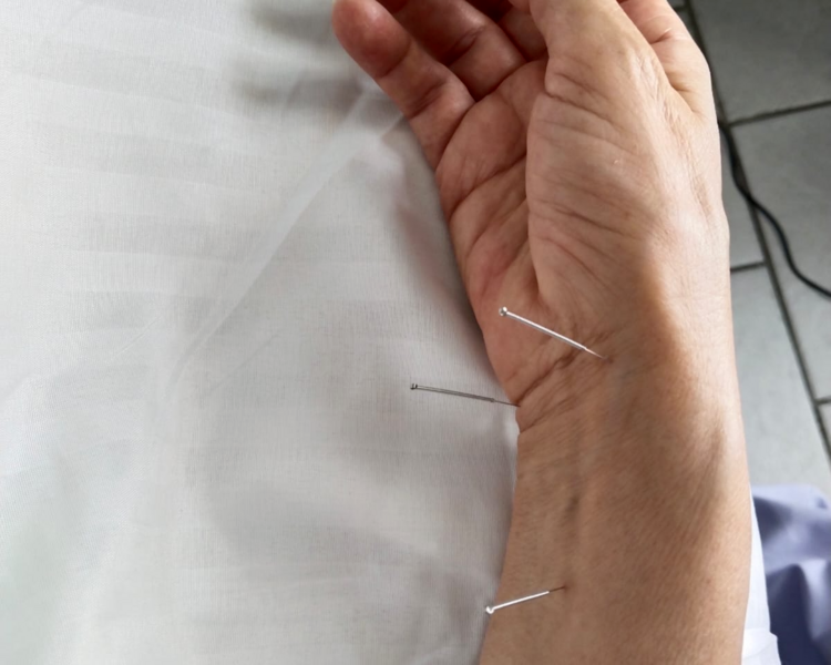 Acupuntura