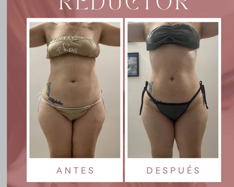 PAQUETE REDUCTOR EN ABDOMEN 10 SESIONES