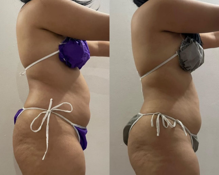 PAQUETE REDUCTOR EN ABDOMEN 15 SESIONES