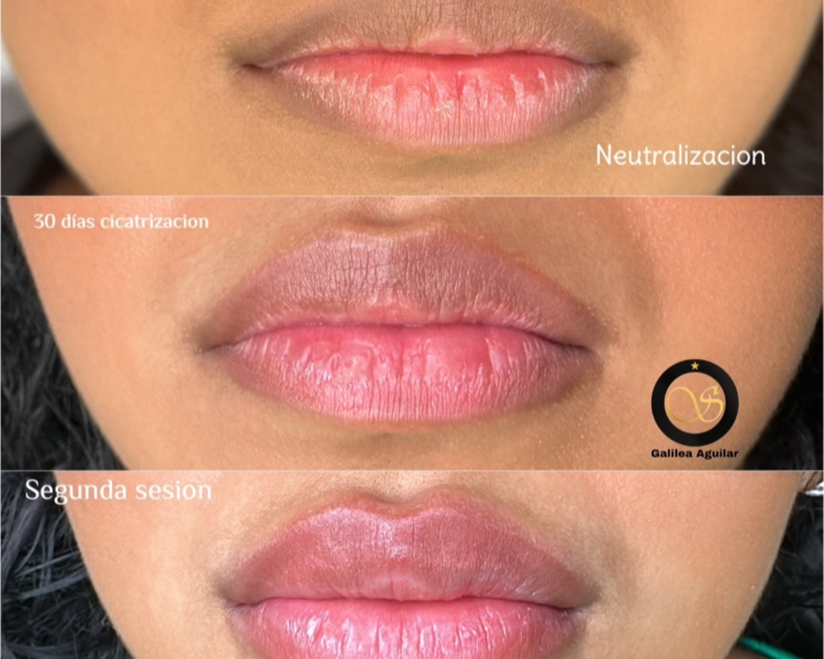 Neutralización de Labios