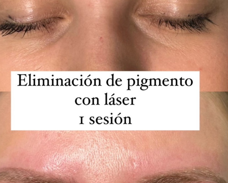 Despigmentación de Cejas