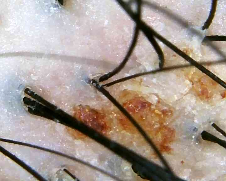 Evaluación Tricóloga 