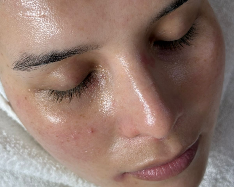 Sesion de Radiofrecuencia fraccionada 