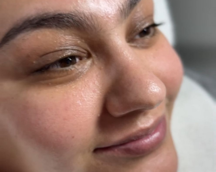 Tratamiento con Dermapen 