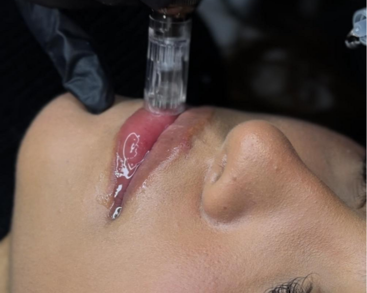 HidraLips paquete x3 sesiones