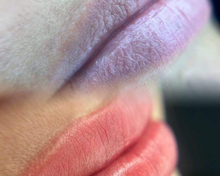 Neutralizacion de labios paquete x3 sesiones