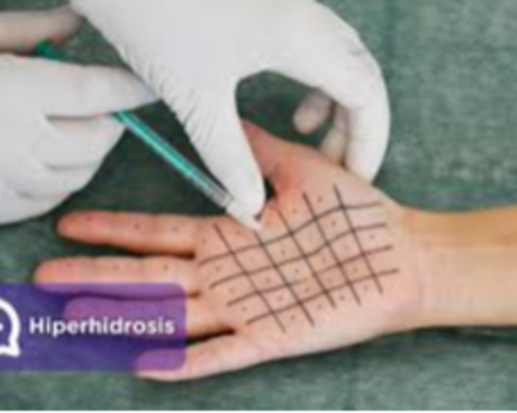 Hiperhidrosis Palmar