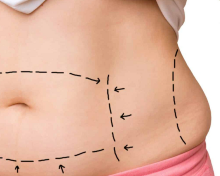 ultracavitación (quemador de grasas)