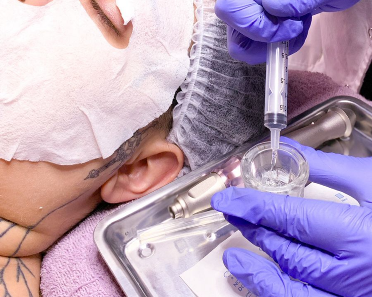 Dermapen facial