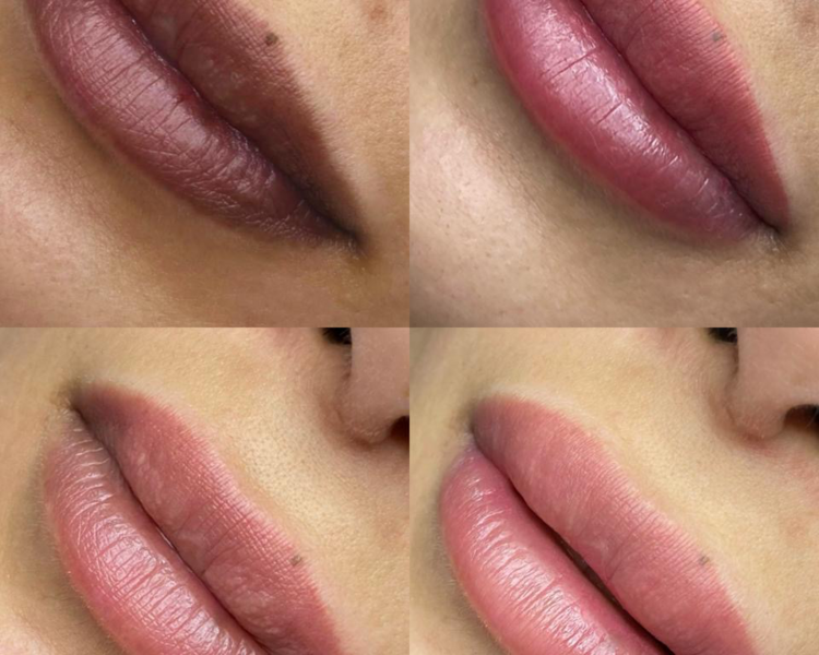 Neutralización de labios 