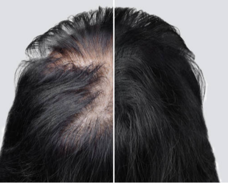 Evaluación Micropigmentación Capilar