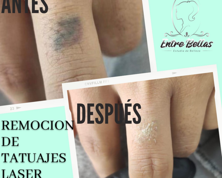 ELIMINACION DE TATAUAJES LASER