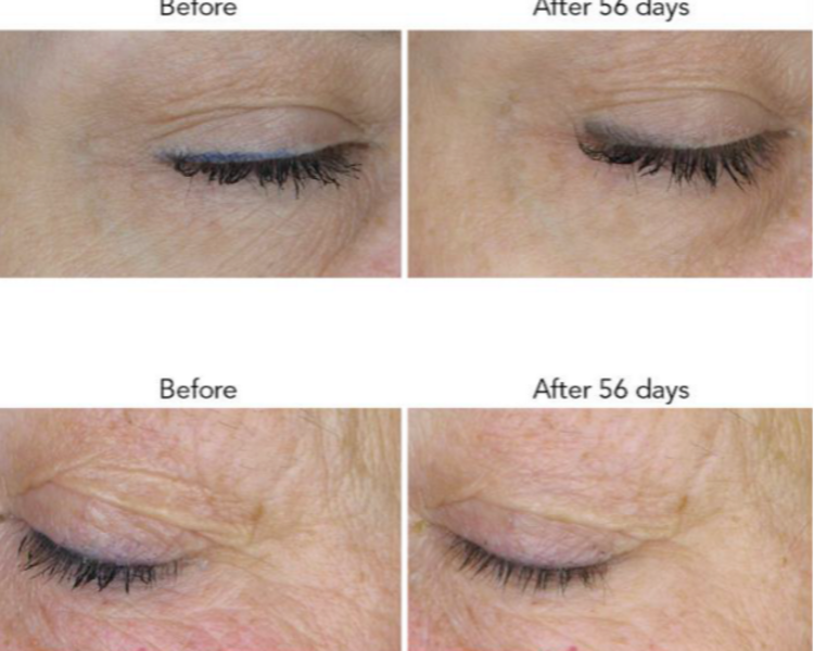 Exosomas Vegetales Rejuvenecimiento facial