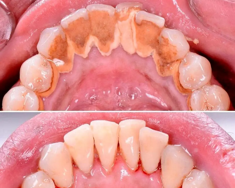 Evaluación + Destartraje + Profilaxis (promoción Noviembre)