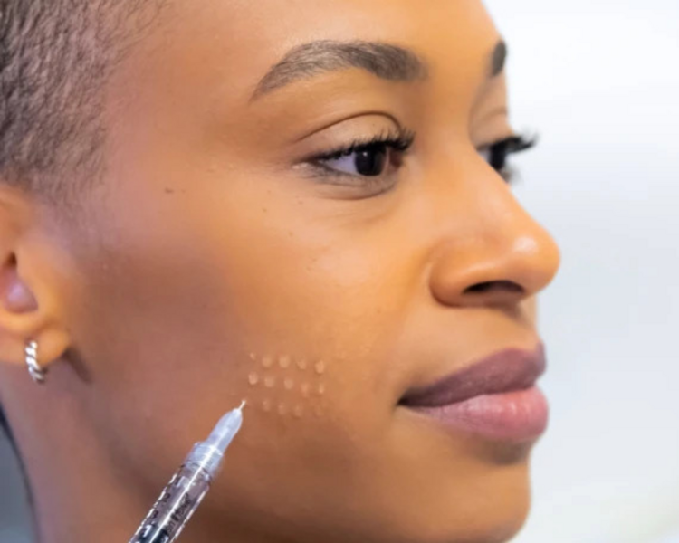 SKIN BOOSTER (1 SESIÓN)