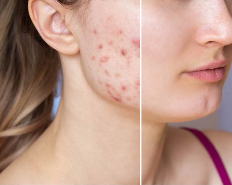 Tratamiento acné - 4 sesiones