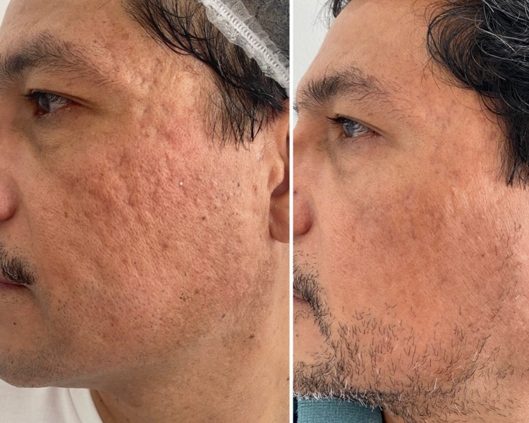 Tratamiento cicatrices de acné - 3 sesiones